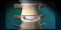 Arthroplastie discale avec prothèse