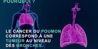Cancer du poumon : les symptômes d'alerte