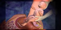L'accouchement par césarienne expliqué en vidéo
