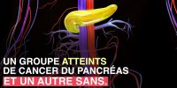 Cancer du pancréas : l'alcootest pourrait aider à le repérer