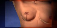 Réduction mammaire en vidéo