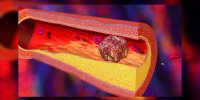 Cholestérol et rupture de la plaque d'athérome en vidéo