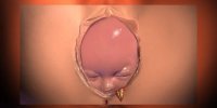 L'épisiotomie expliquée en vidéo