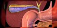 Ablation de la vésicule biliaire en vidéo