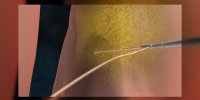 La liposuccion expliquée en vidéo