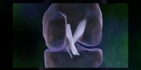La rupture du ligament croisé antérieur expliquée en vidéo