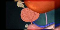 L'hyperplasie bénigne de la prostate expliquée en vidéo