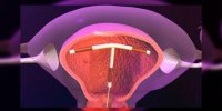 Le dispositif intra-utérin, expliqué en vidéo