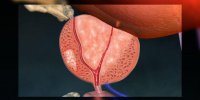 Le cancer de la prostate en vidéo