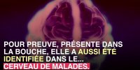 Saignement des gencives et maladie d'Alzheimer : un lien ?