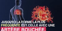Infarctus : une forme sans obstruction existe