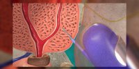 La biopsie de la prostate par aspiration (vidéo)
