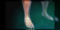 Neuropathie diabétique