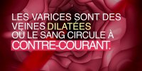 Comment une varice peut révéler un caillot de sang
