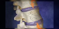 Fractures II