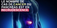 Cancer du pancréas : le diagnostiquer par un prélèvement sur la langue