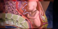 Le décollement placentaire expliqué en vidéo