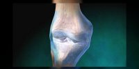 Le rhumatisme chronique du genou en vidéo