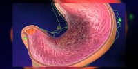 Le cancer de l'estomac en vidéo