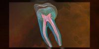 La dévitalisation d'une dent expliquée en vidéo