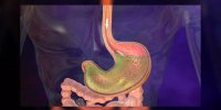 Les ulcères gastriques en vidéo