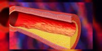 Hyperlipidémie : le cholestérol expliqué en vidéo