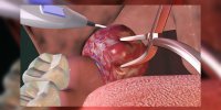 L'amygdalectomie expliquée en vidéo