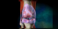 L'arthrose expliquée en vidéo