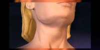 La liposuccion du menton en vidéo