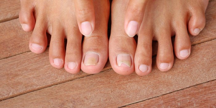 Ongle Ecrase Ou Arrache