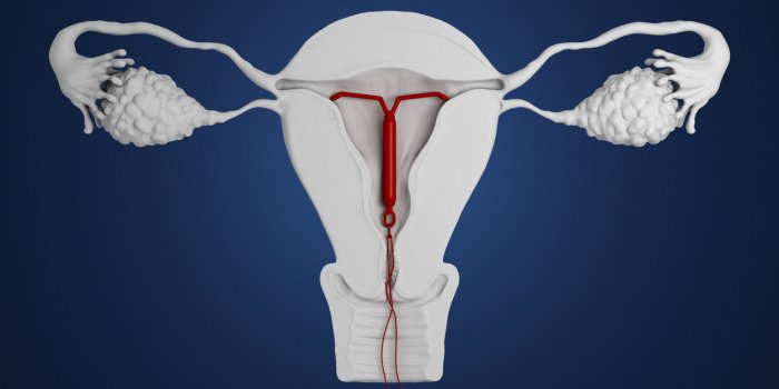 Contraception : des stérilets suspendus pour risque de perte ou ...