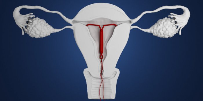 Contraception Des Sterilets Suspendus Pour Risque De Perte Ou
