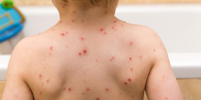 Boutons rouges : comment savoir si c'est une maladie infantile ?