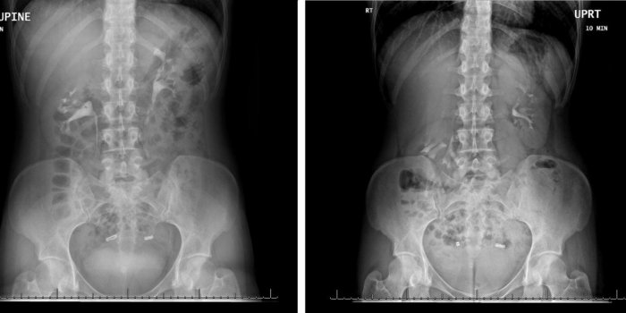 Akshay Sood et Craig Rogers, BMJ Case Reports (2018)