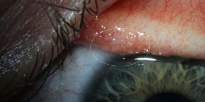 Photo : The American Journal of Tropical medecine and hygiene