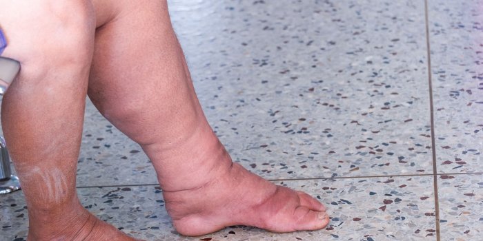 Les 5 symptomes de la maladie des "jambes poteaux"