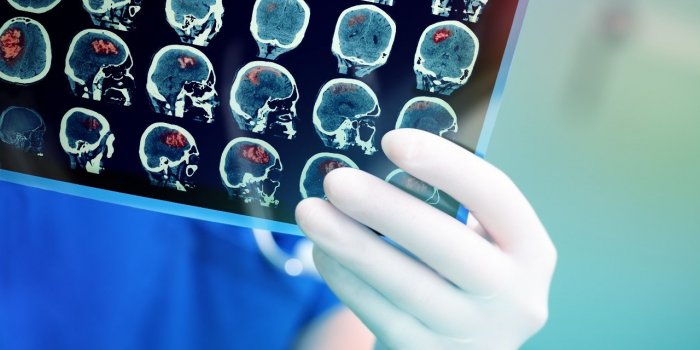 AVC : 5 gestes pour le prevenir