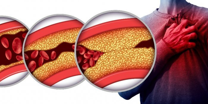 Atherosclerose : 5 signes que vos arteres sont bouchees 