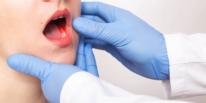 5 symptomes de cancer buccal a surveiller