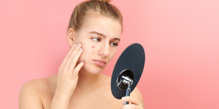 Acne, probleme de peau : 5 aliments qui donnent des boutons