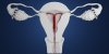Contraception : trois stérilets suspendus par l’ANSM