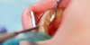 Déchaussement dentaire : le rôle méconnu du tartre