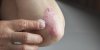 Psoriasis : 5 solutions naturelles