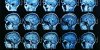 Et si le stress réduisait la taille du cerveau ?