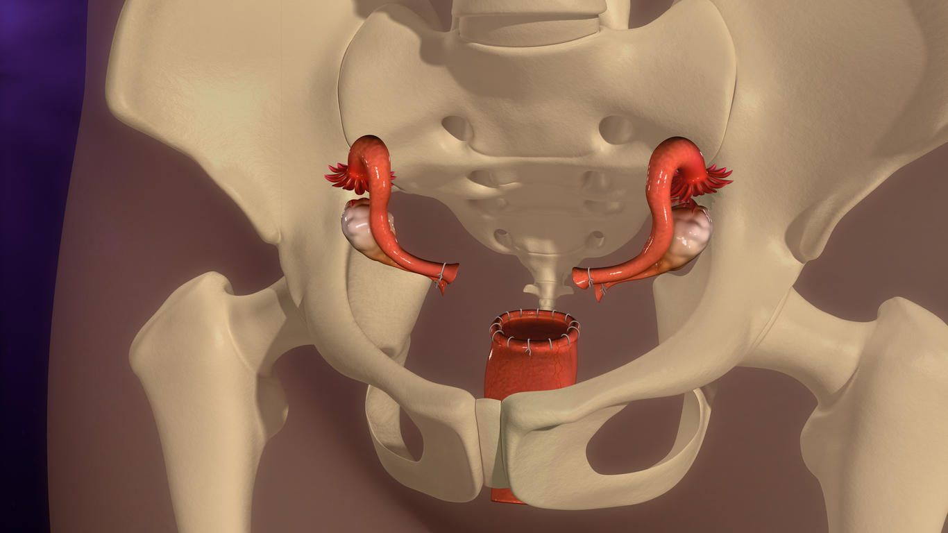 Hystérectomie, ablation de l'utérus, conséquences d'une hystérectomie — free download