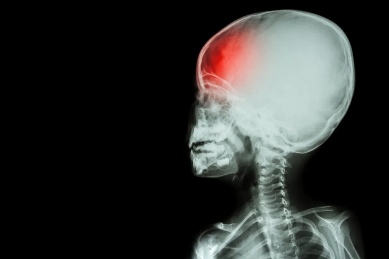 film x-ray body of child and headache ( brain disease ) ( isolated ) film x-ray body of child and headache ( brain disease ) ( isolated )