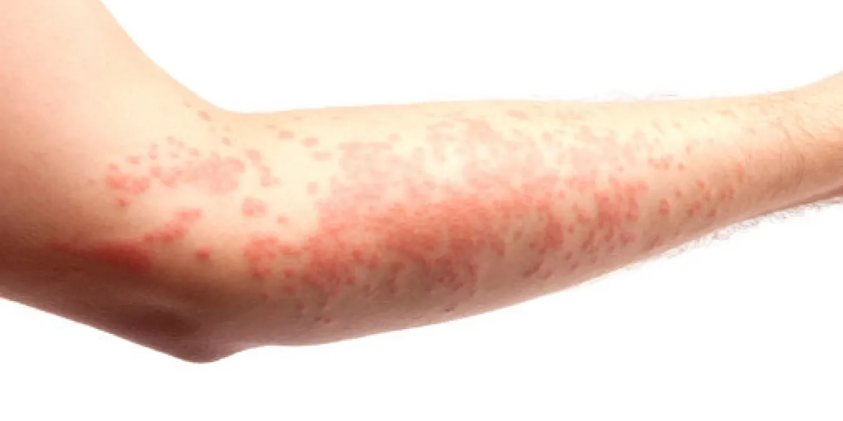 arm covered in a skin allergy,hives arm covered in a skin allergy,hives