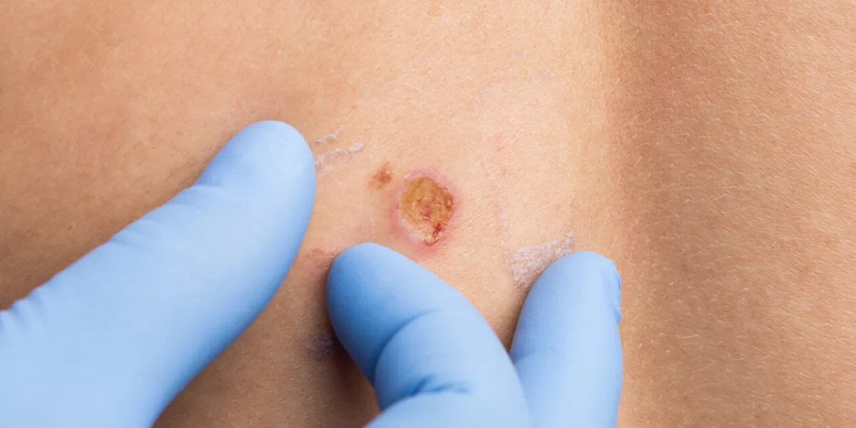 mold removal concept with doctor hands examining the skin after laser surgery mold removal concept with doctor hands examining the skin after laser surgery