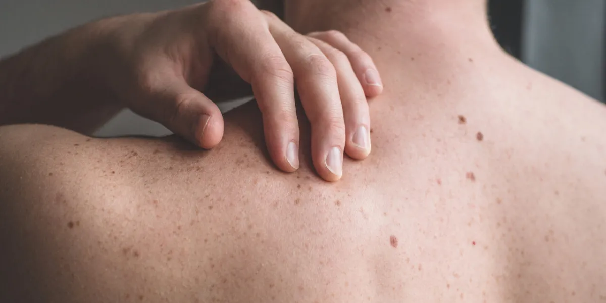 checking benign moles close up detail of the bare skin on a man checking benign moles close up detail of the bare skin on a man