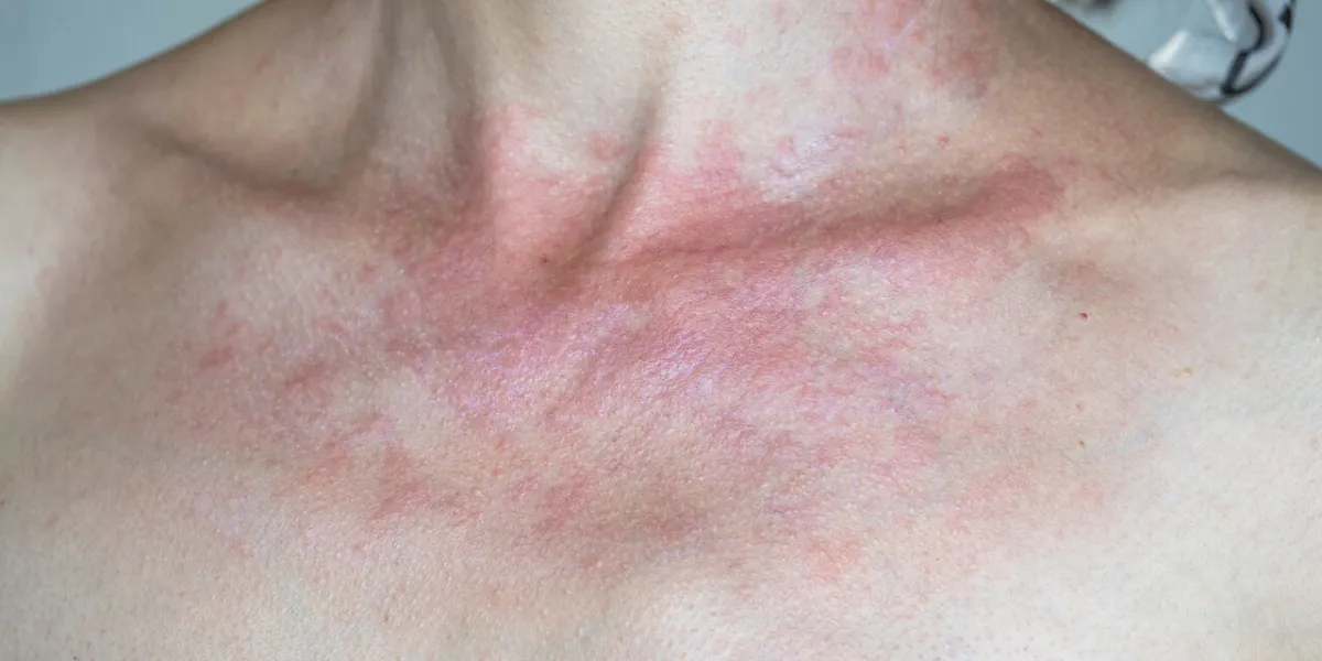 solar dermatitis woman with red sunburned skin against gray background, closeup solar dermatitis woman with red sunburned skin against gray background, closeup